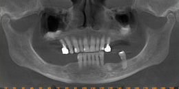 Implantodontia - foto 03